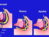apneia-do-sono