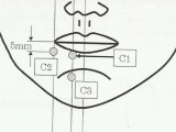 Parestesia