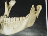 Fratura-do-Côndilo-Mandibular