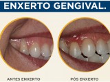 06_post_enxerto_gengival1
