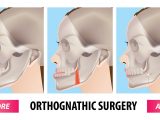 Comparação das mudanças na qualidade de vida entre os pacientes padrão II (dois) e III (três) de face durante e após o tratamento ortodôntico-cirúrgico