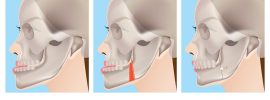 Comparação das mudanças na qualidade de vida entre os pacientes padrão II (dois) e III (três) de face durante e após o tratamento ortodôntico-cirúrgico