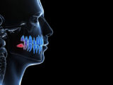 Tumor Maligno de Glândula Salivar no Osso Mandibular?