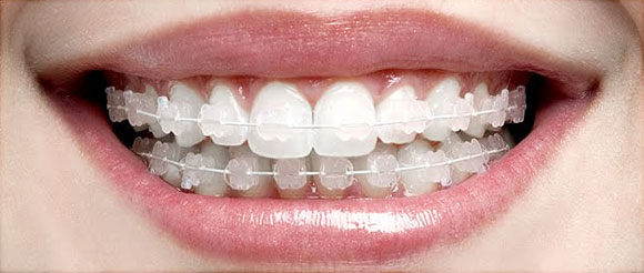 ortodontia-aparelho-estetico