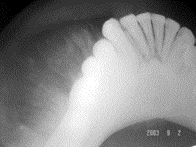 osteosarcoma